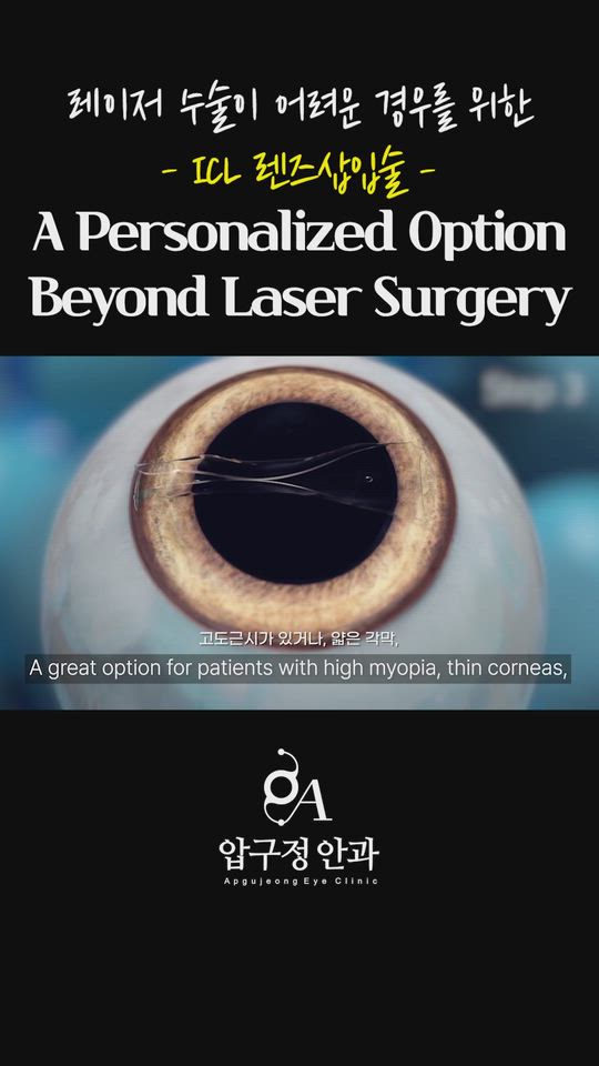 ICL Lens Implantation for Cases Where Laser Surgery Is Not Suitable