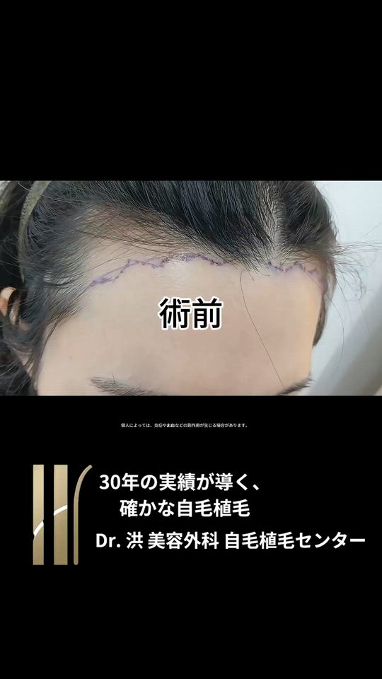 女性ヘアライン矯正、10ヶ月後の変化